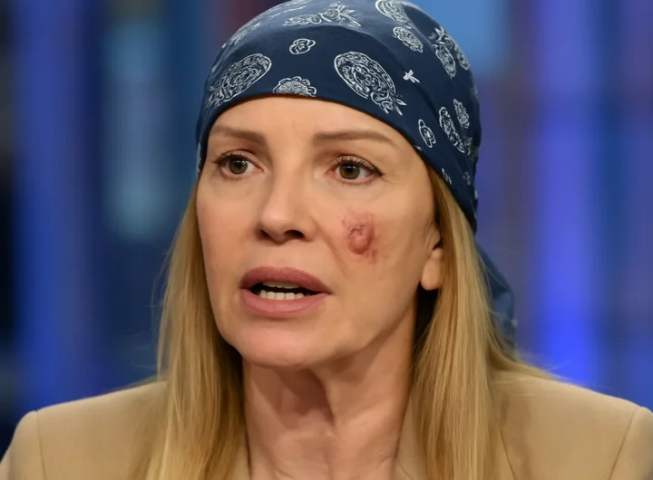 Rita Rusic racconta il tumore della pelle a La Volta Buona: dalla diagnosi sbagliata alla bandana